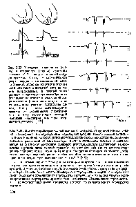 Рис. 2.23. <a href="/info/1076792">Механизмы первичного</a> (слева) и вторичного (справа) смещения сегмента S-T электро- и магнитокардиограммы. Вверху - схематический разрез сердца с заштрихованной патологической областыо (стрелкой показан <a href="/info/1890185">эквивалентный дипольный</a> момент токов повреждения). В <a href="/info/916048">средней части</a> рисунка - Импульсы <a href="/info/1394125">трансмембранного потенциала действия</a> в неизмененной части миокарда (сплошная линия) и на патологическом участке (штриховая ли- ния). Внизу - цикл магнитокардиограммы со смещенными сегментами S-T я T-Q <a href="/info/776110">относительно истинной</a> изолинии (смещения показаны жирными стрелками) [175]